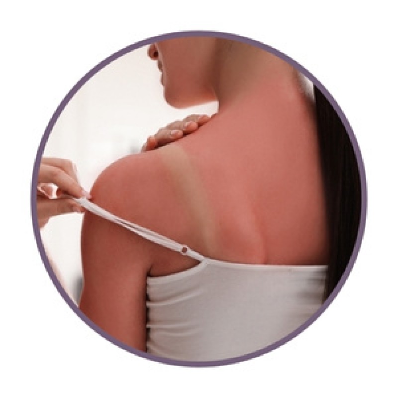 Мехлеми с билки за изгаряния