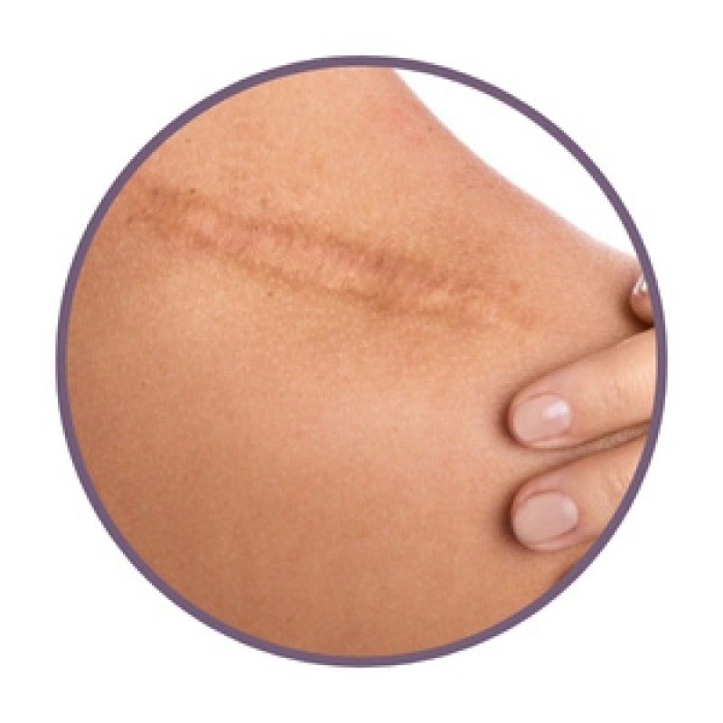 Мехлеми с билки за белези